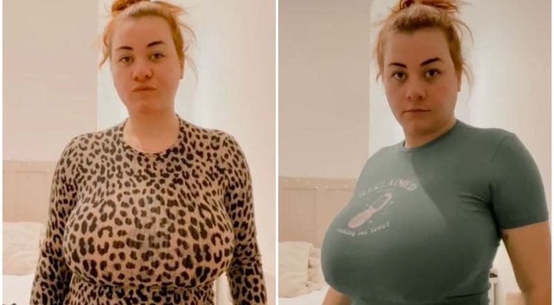 5 kg krūtinę kentusi mergina ryžosi operacijai: štai, kaip ji atrodo dabar